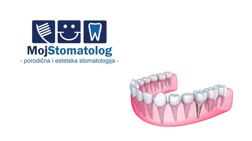 Zubni implantat