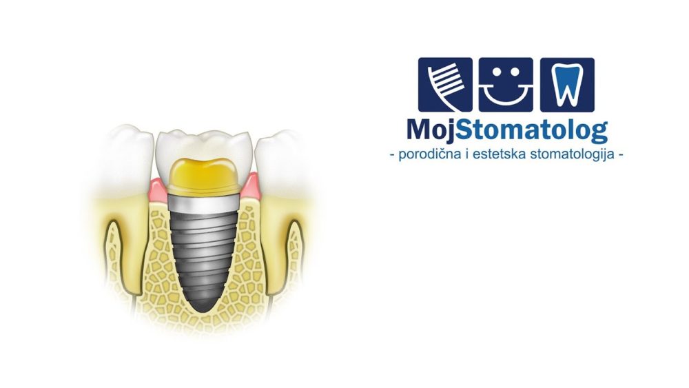 Izrada krunice na implantatu