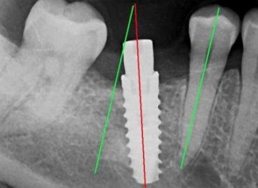 Komplikacije implantata