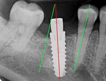 Komplikacije implantata