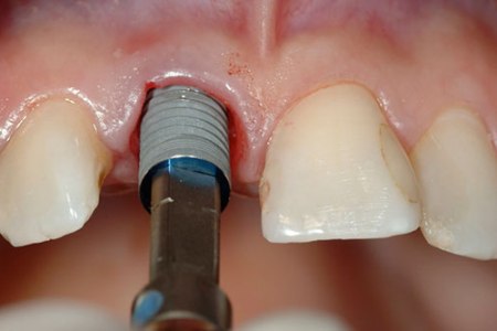 Imedijatna ugradnja implantata